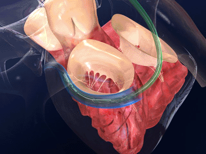 Image: The Carillon Mitral Contour System, designed to reshape the valvular dimensions, tighten the valve leaflets, and reduce mitral regurgitation (Photo courtesy of Cardiac Dimensions).